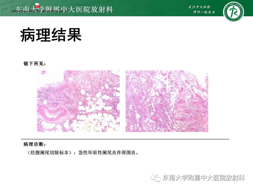 影像PPT - 【PPT】阑尾黏液性肿瘤-16