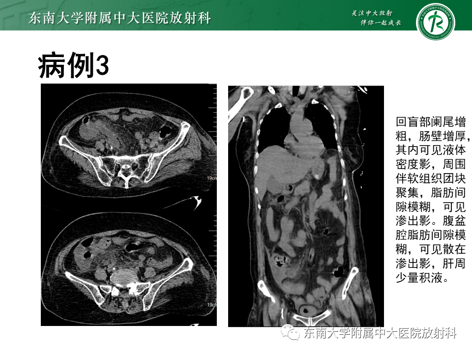 影像PPT - 【PPT】阑尾黏液性肿瘤-15