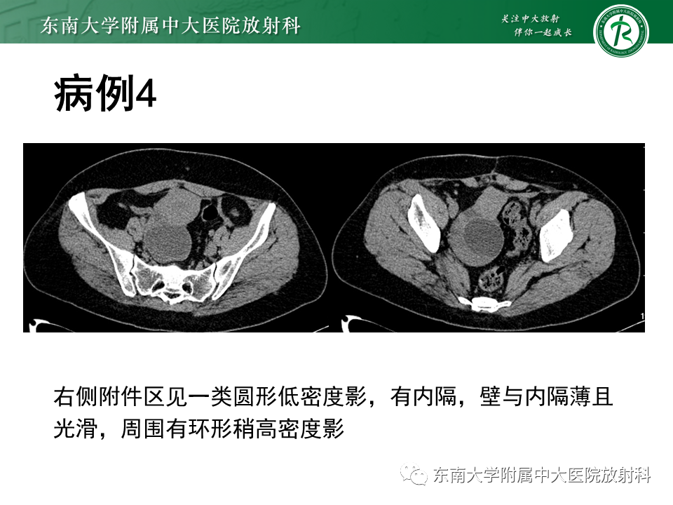影像PPT - 【PPT】阑尾黏液性肿瘤-18