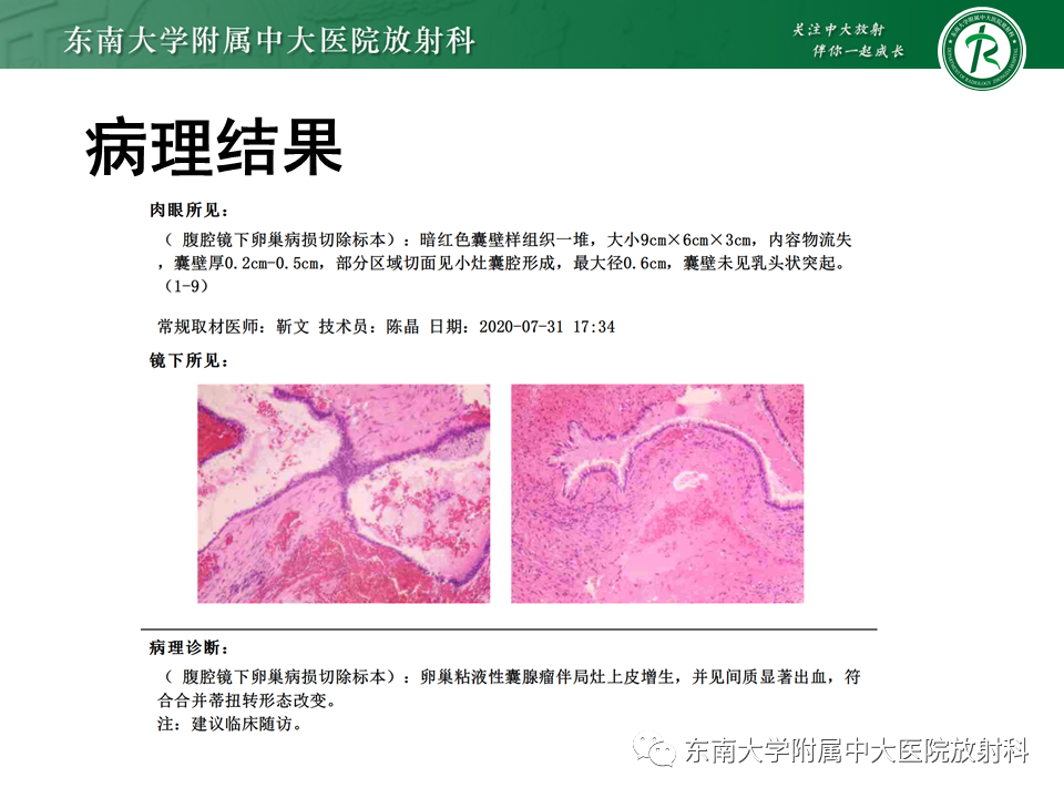 影像PPT - 【PPT】阑尾黏液性肿瘤-19