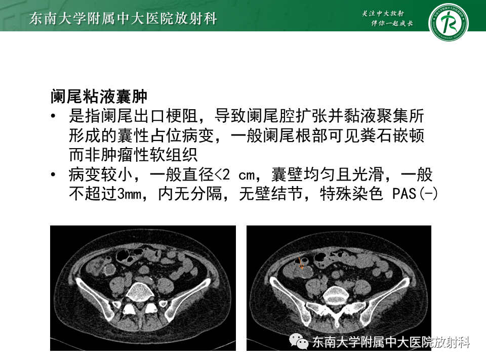 影像PPT - 【PPT】阑尾黏液性肿瘤-20