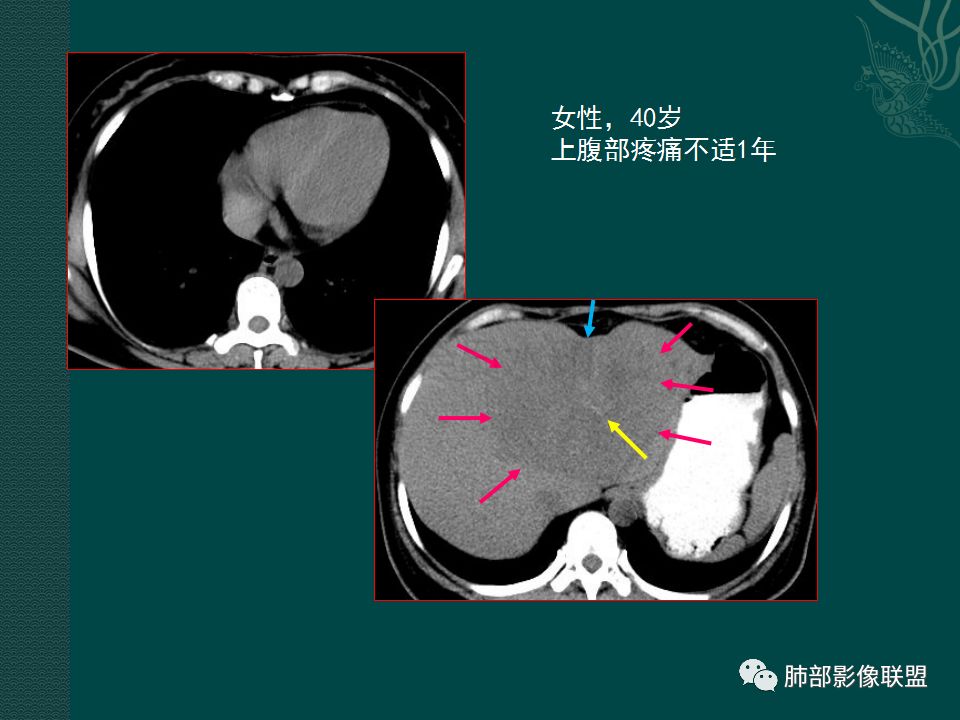 影像PPT - 【PPT】胃肠道肿瘤特征性影像浅析-3 影像PPT - 【PPT】胃肠道肿瘤特征性影像浅析-3