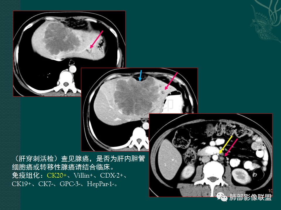 影像PPT - 【PPT】胃肠道肿瘤特征性影像浅析-4 影像PPT - 【PPT】胃肠道肿瘤特征性影像浅析-4
