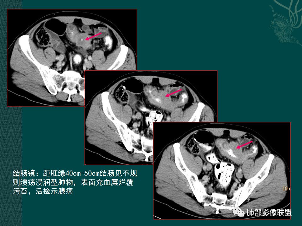 影像PPT - 【PPT】胃肠道肿瘤特征性影像浅析-15 影像PPT - 【PPT】胃肠道肿瘤特征性影像浅析-15