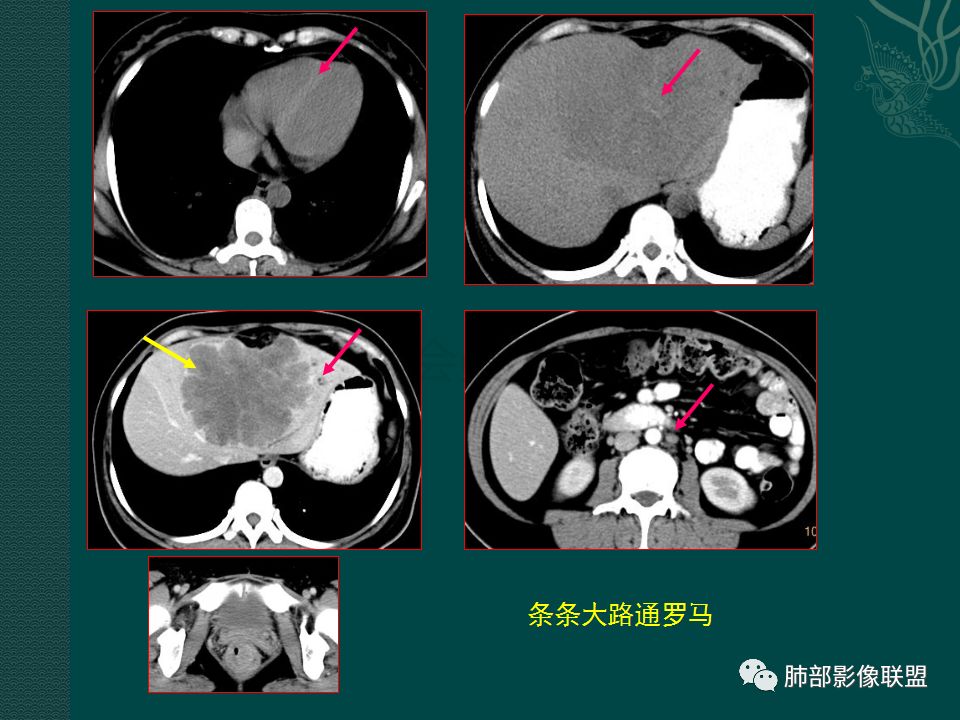 影像PPT - 【PPT】胃肠道肿瘤特征性影像浅析-24 影像PPT - 【PPT】胃肠道肿瘤特征性影像浅析-24