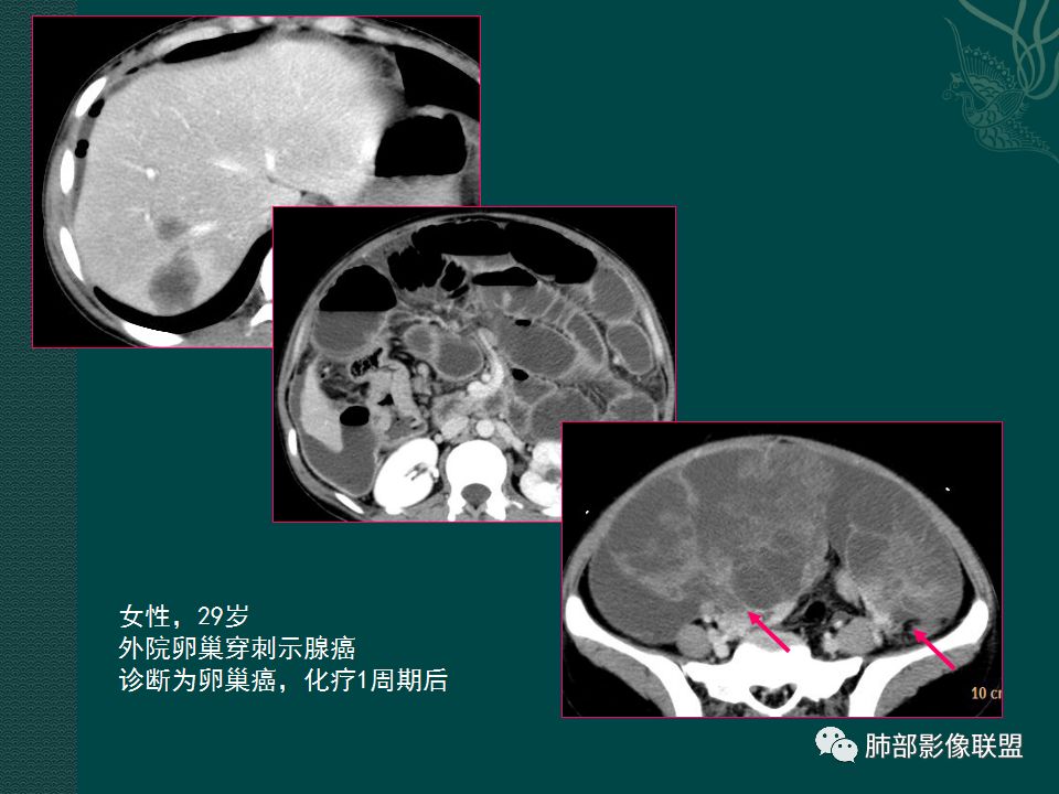 影像PPT - 【PPT】胃肠道肿瘤特征性影像浅析-42 影像PPT - 【PPT】胃肠道肿瘤特征性影像浅析-42