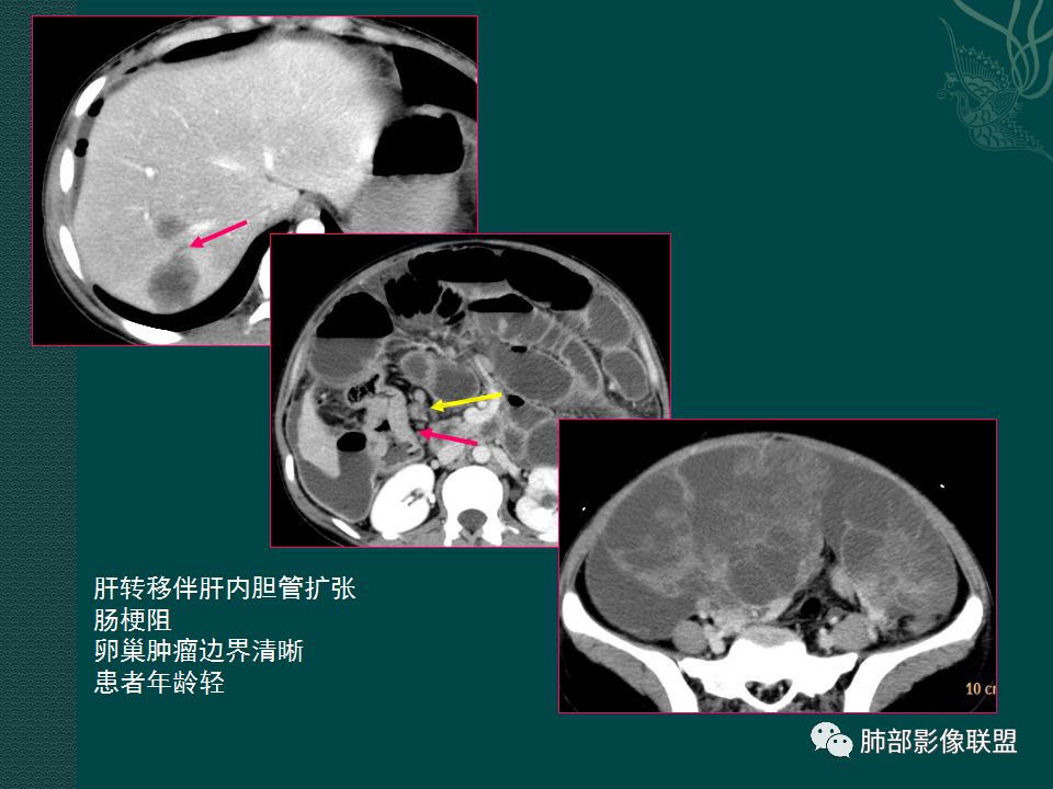 影像PPT - 【PPT】胃肠道肿瘤特征性影像浅析-43 影像PPT - 【PPT】胃肠道肿瘤特征性影像浅析-43