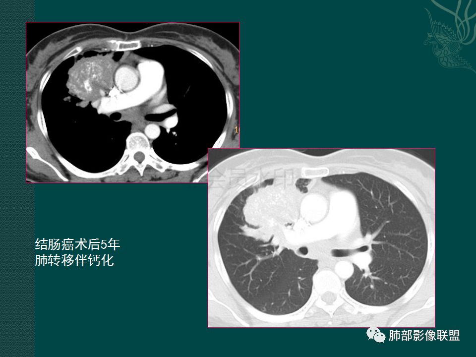 影像PPT - 【PPT】胃肠道肿瘤特征性影像浅析-40 影像PPT - 【PPT】胃肠道肿瘤特征性影像浅析-40