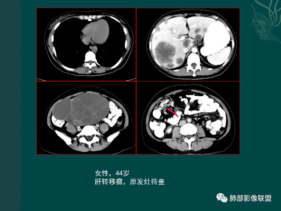 影像PPT - 【PPT】胃肠道肿瘤特征性影像浅析-50 影像PPT - 【PPT】胃肠道肿瘤特征性影像浅析-50