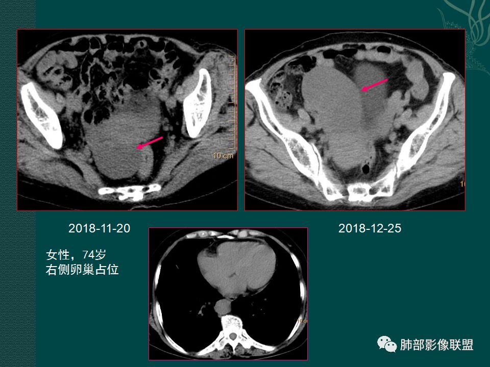 影像PPT - 【PPT】胃肠道肿瘤特征性影像浅析-54 影像PPT - 【PPT】胃肠道肿瘤特征性影像浅析-54