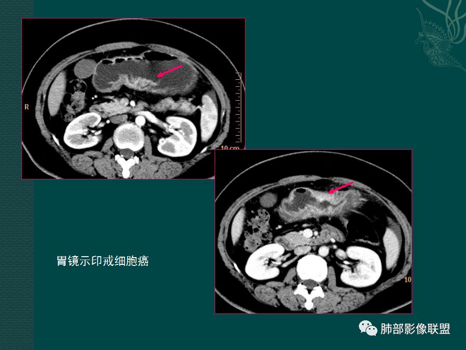 影像PPT - 【PPT】胃肠道肿瘤特征性影像浅析-57 影像PPT - 【PPT】胃肠道肿瘤特征性影像浅析-57