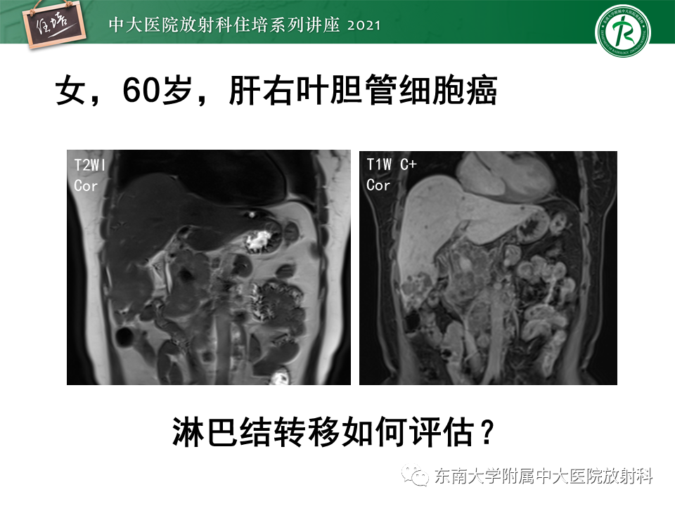 影像PPT - 【PPT】腹部淋巴结分区及影像分析-3
