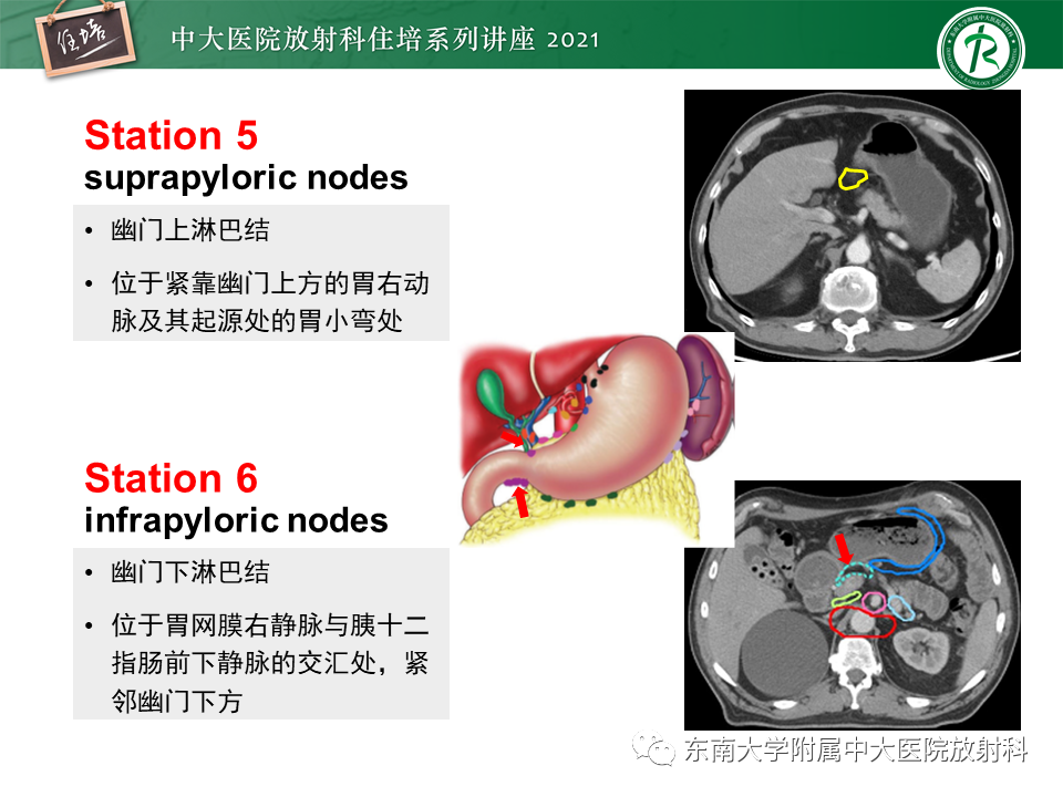 影像PPT - 【PPT】腹部淋巴结分区及影像分析-17