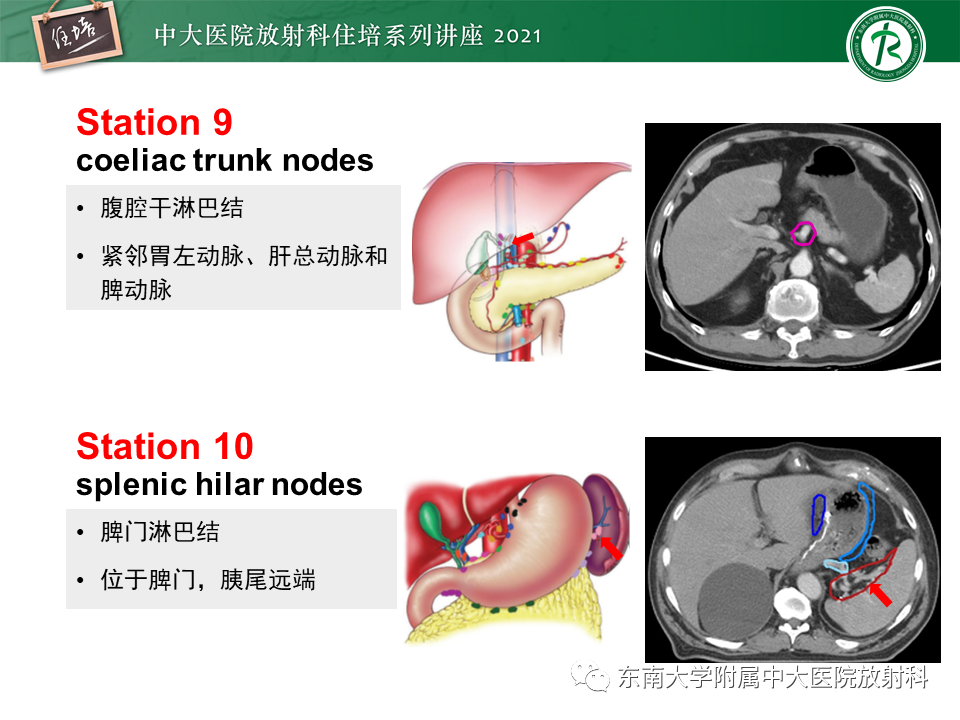 影像PPT - 【PPT】腹部淋巴结分区及影像分析-19