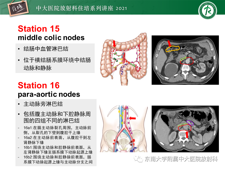 影像PPT - 【PPT】腹部淋巴结分区及影像分析-22