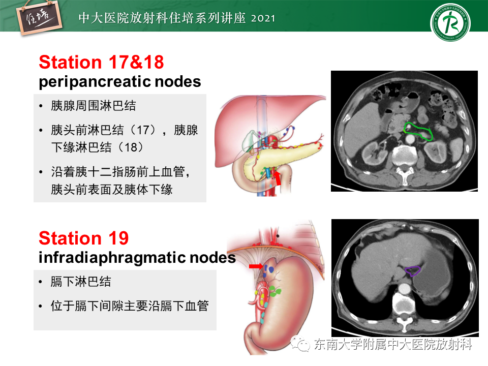 影像PPT - 【PPT】腹部淋巴结分区及影像分析-23