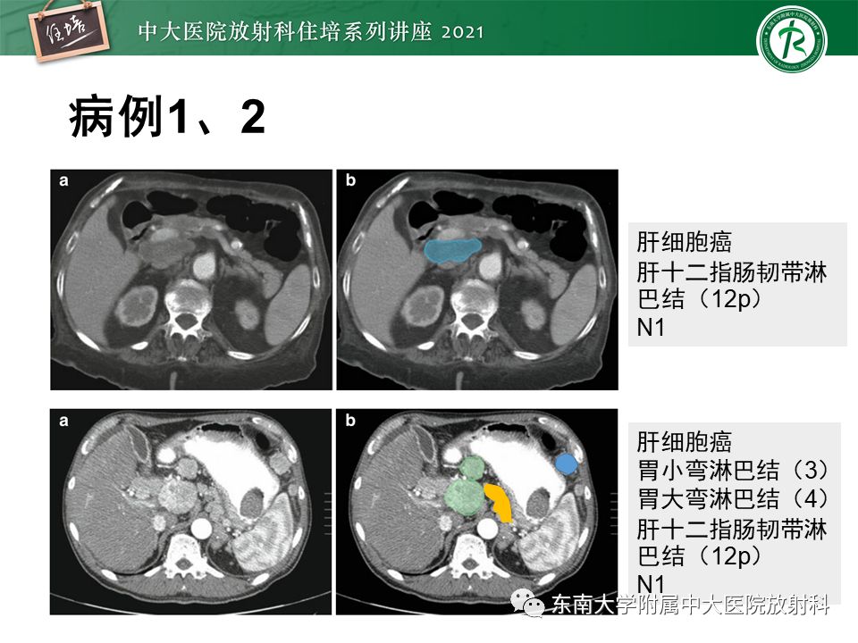 影像PPT - 【PPT】腹部淋巴结分区及影像分析-26