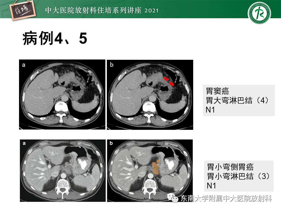 影像PPT - 【PPT】腹部淋巴结分区及影像分析-30