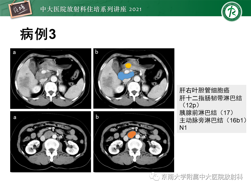 影像PPT - 【PPT】腹部淋巴结分区及影像分析-28