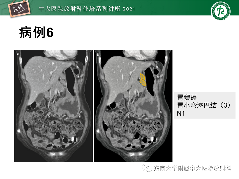 影像PPT - 【PPT】腹部淋巴结分区及影像分析-31