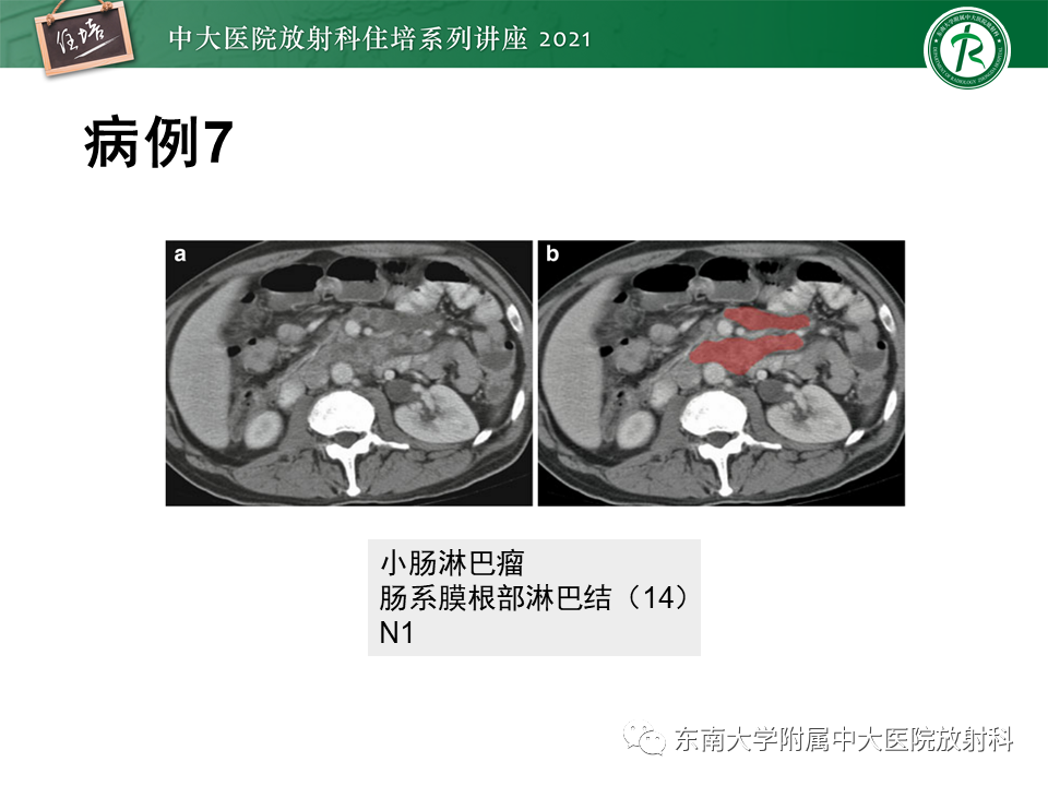 影像PPT - 【PPT】腹部淋巴结分区及影像分析-33