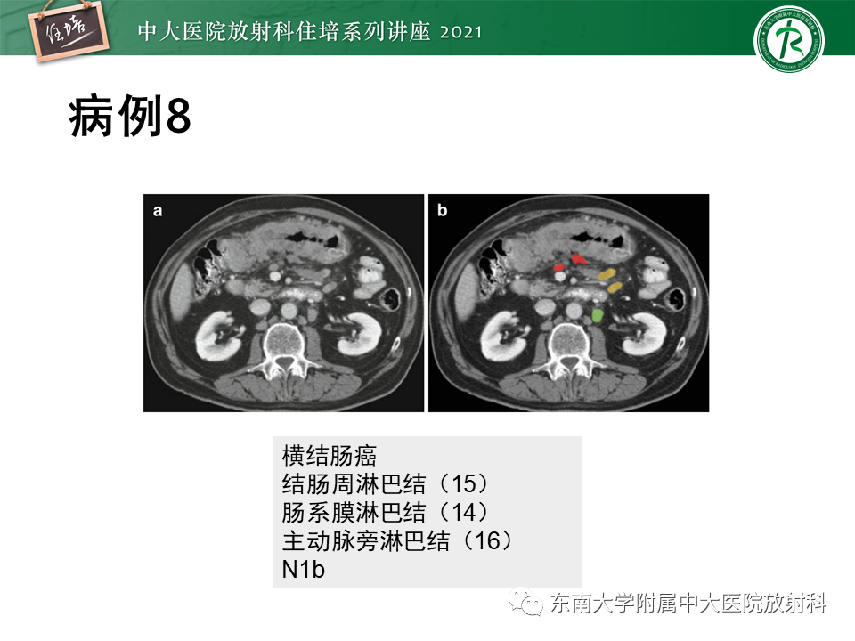 影像PPT - 【PPT】腹部淋巴结分区及影像分析-35
