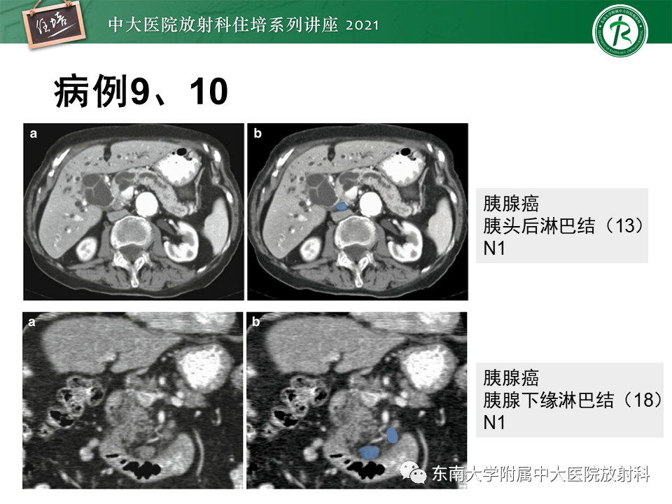影像PPT - 【PPT】腹部淋巴结分区及影像分析-37