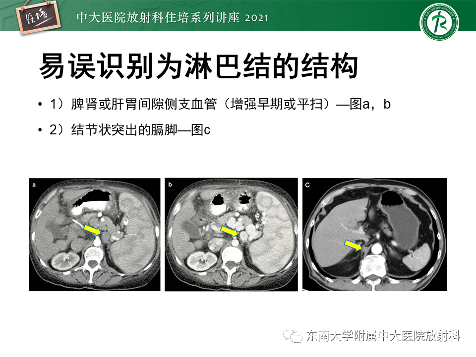 影像PPT - 【PPT】腹部淋巴结分区及影像分析-53