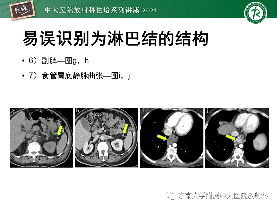 影像PPT - 【PPT】腹部淋巴结分区及影像分析-55