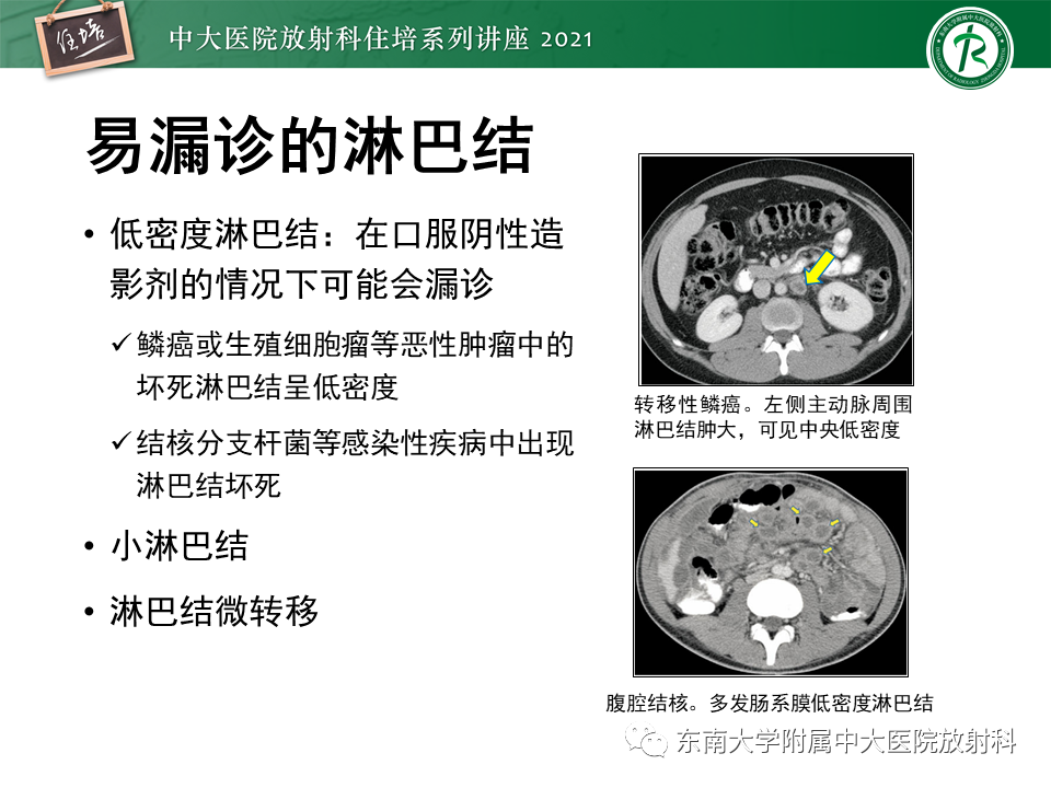 影像PPT - 【PPT】腹部淋巴结分区及影像分析-56