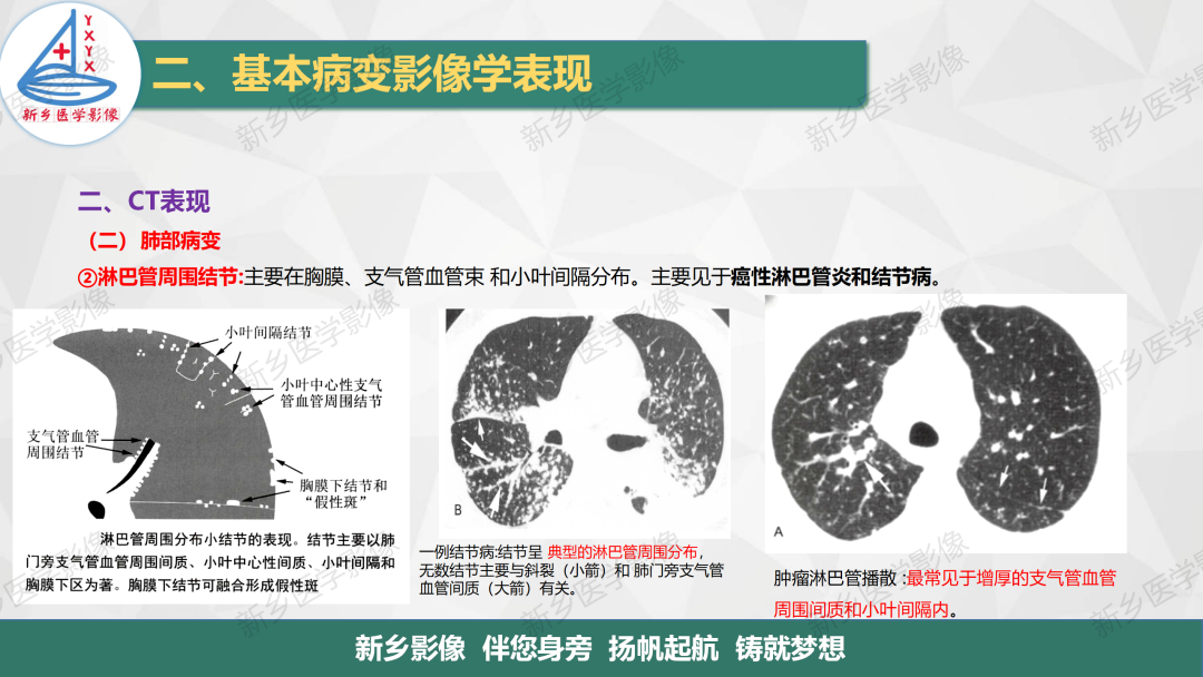影像PPT - 【PPT】医学影像诊断学教材解读—呼吸基本病变影像表现3-11