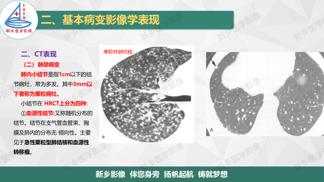 影像PPT - 【PPT】医学影像诊断学教材解读—呼吸基本病变影像表现3-10