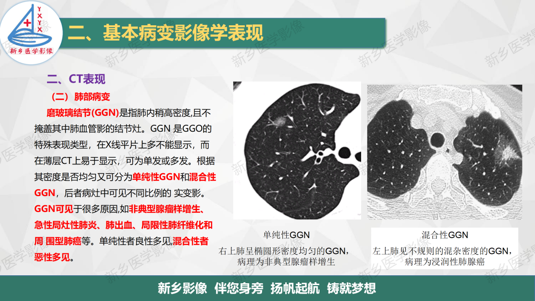 影像PPT - 【PPT】医学影像诊断学教材解读—呼吸基本病变影像表现3-9