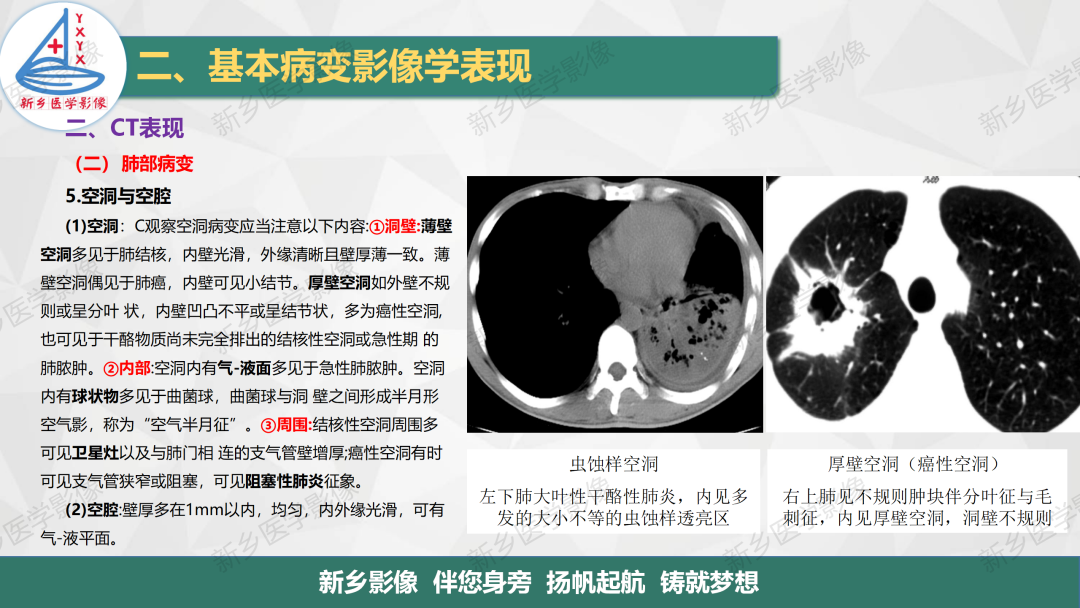 影像PPT - 【PPT】医学影像诊断学教材解读—呼吸基本病变影像表现3-14