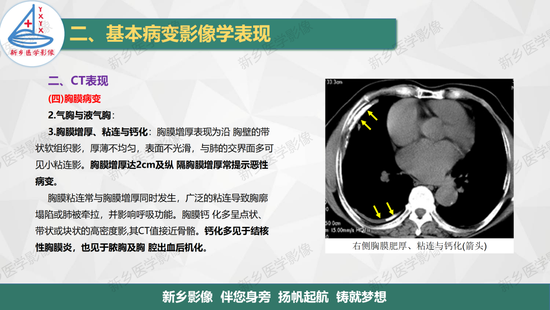 影像PPT - 【PPT】医学影像诊断学教材解读—呼吸基本病变影像表现3-20