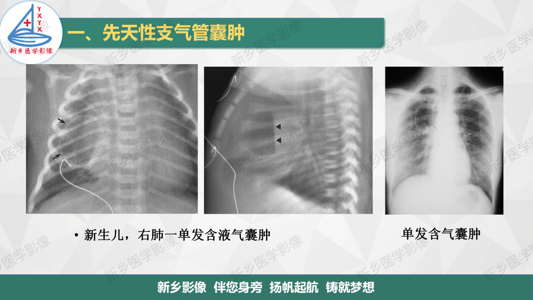 影像PPT - 【PPT】医学影像诊断学教材解读—气管和支气管病变-5