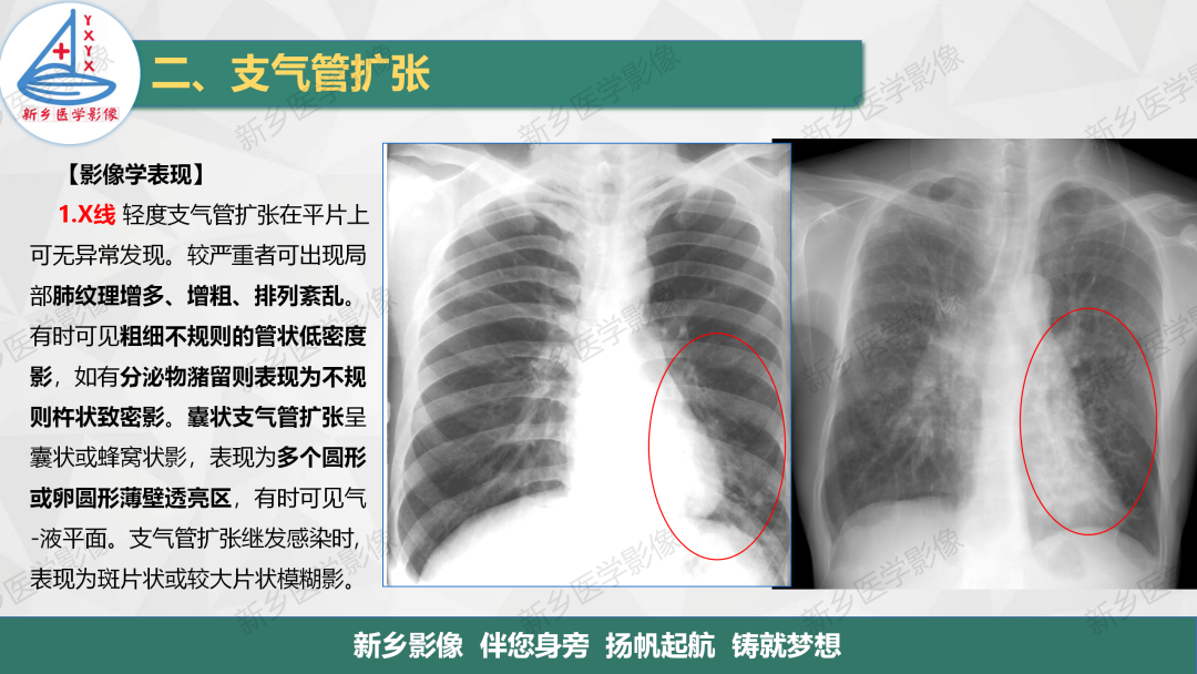 影像PPT - 【PPT】医学影像诊断学教材解读—气管和支气管病变-9