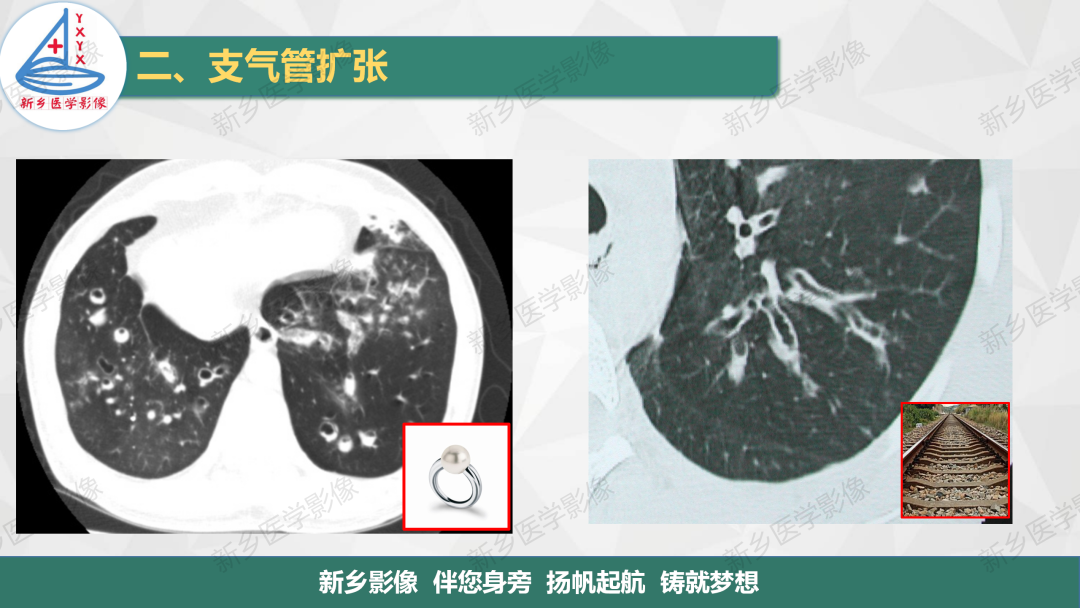 影像PPT - 【PPT】医学影像诊断学教材解读—气管和支气管病变-11
