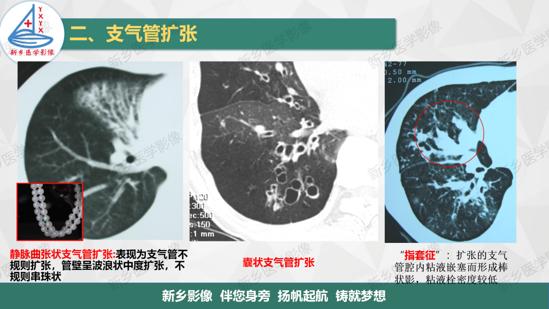 影像PPT - 【PPT】医学影像诊断学教材解读—气管和支气管病变-12