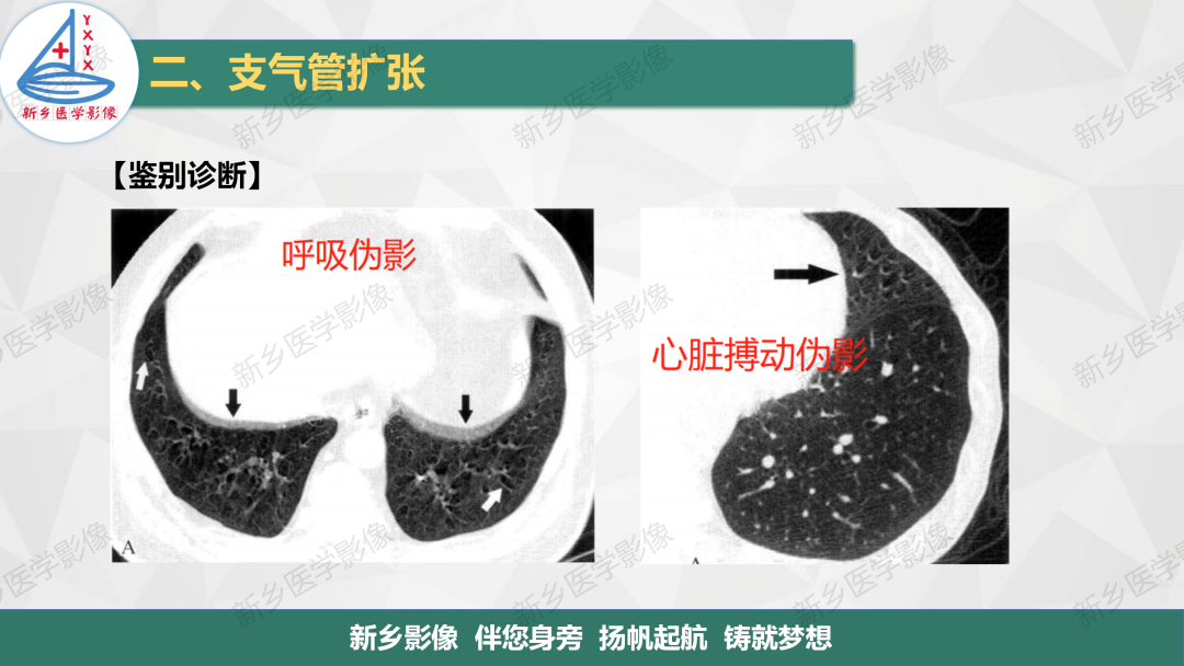 影像PPT - 【PPT】医学影像诊断学教材解读—气管和支气管病变-13