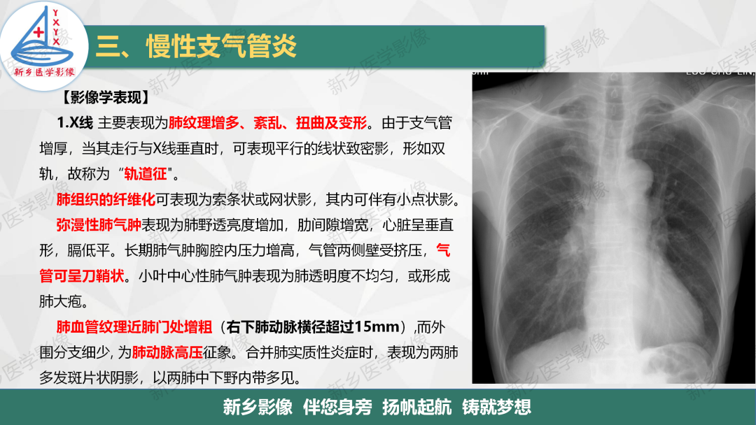 影像PPT - 【PPT】医学影像诊断学教材解读—气管和支气管病变-16