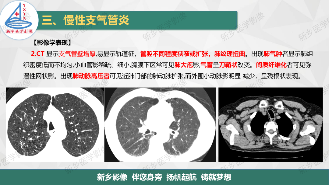 影像PPT - 【PPT】医学影像诊断学教材解读—气管和支气管病变-17