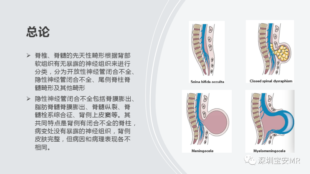影像PPT - 【PPT】隐性神经管闭合不全的影像诊断-2