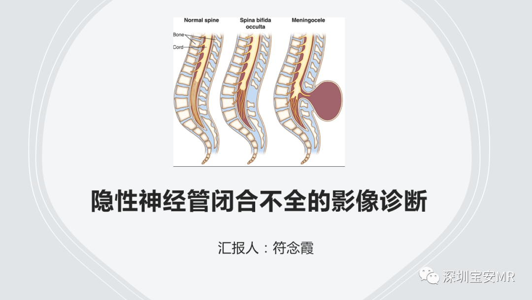 影像PPT - 【PPT】隐性神经管闭合不全的影像诊断-1