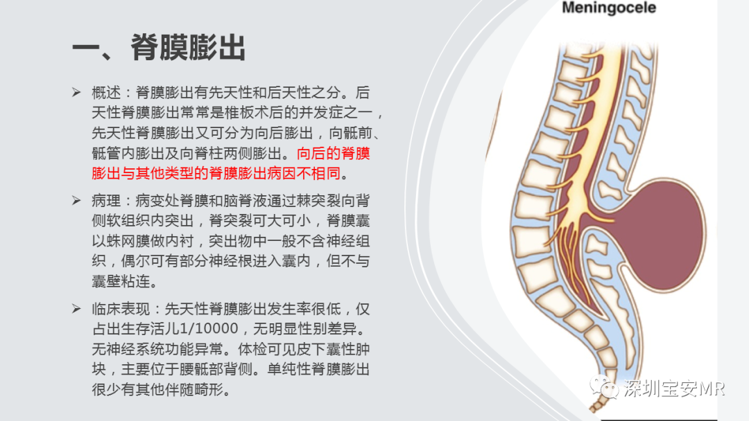 影像PPT - 【PPT】隐性神经管闭合不全的影像诊断-4