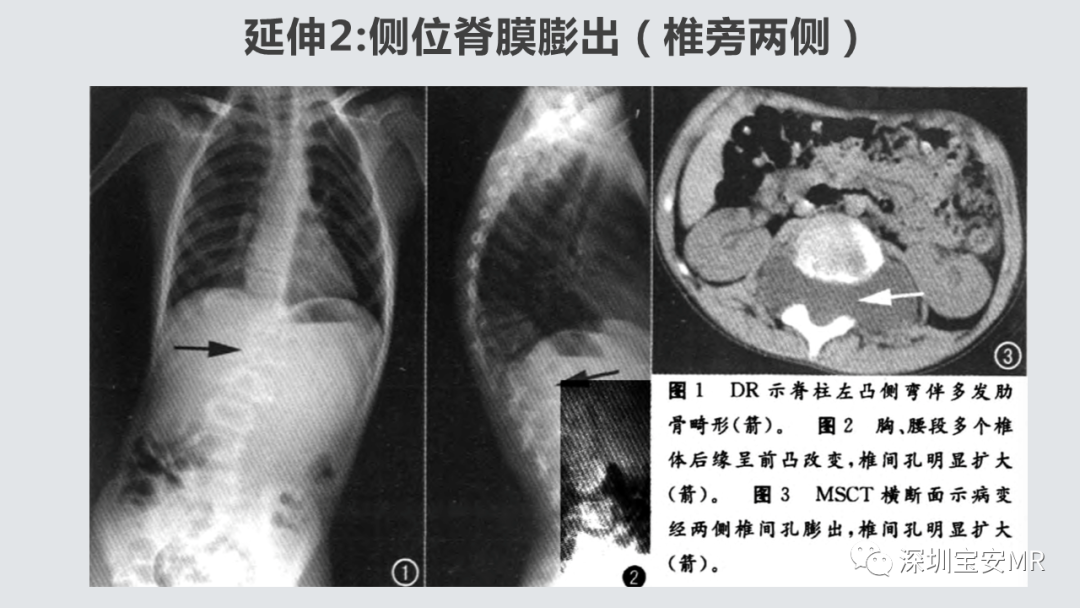 影像PPT - 【PPT】隐性神经管闭合不全的影像诊断-7
