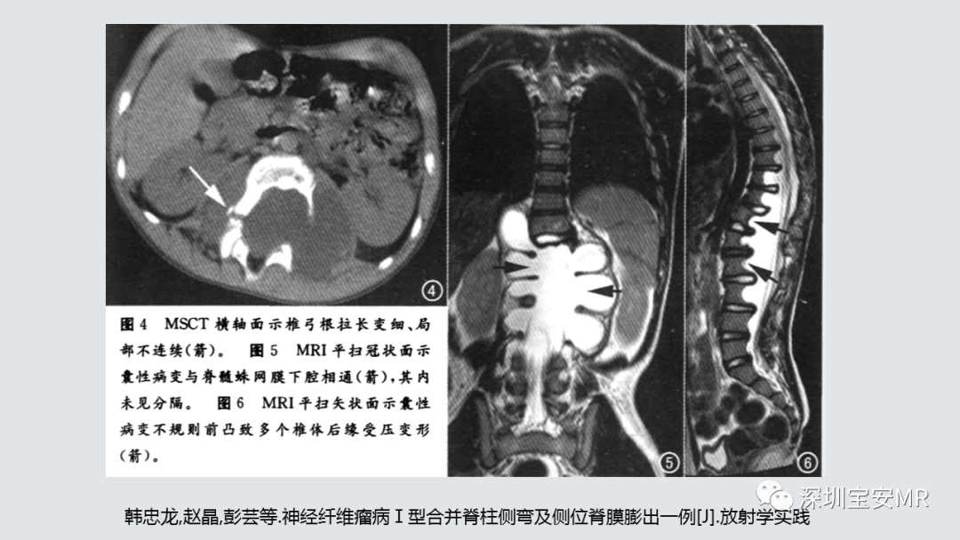 影像PPT - 【PPT】隐性神经管闭合不全的影像诊断-8