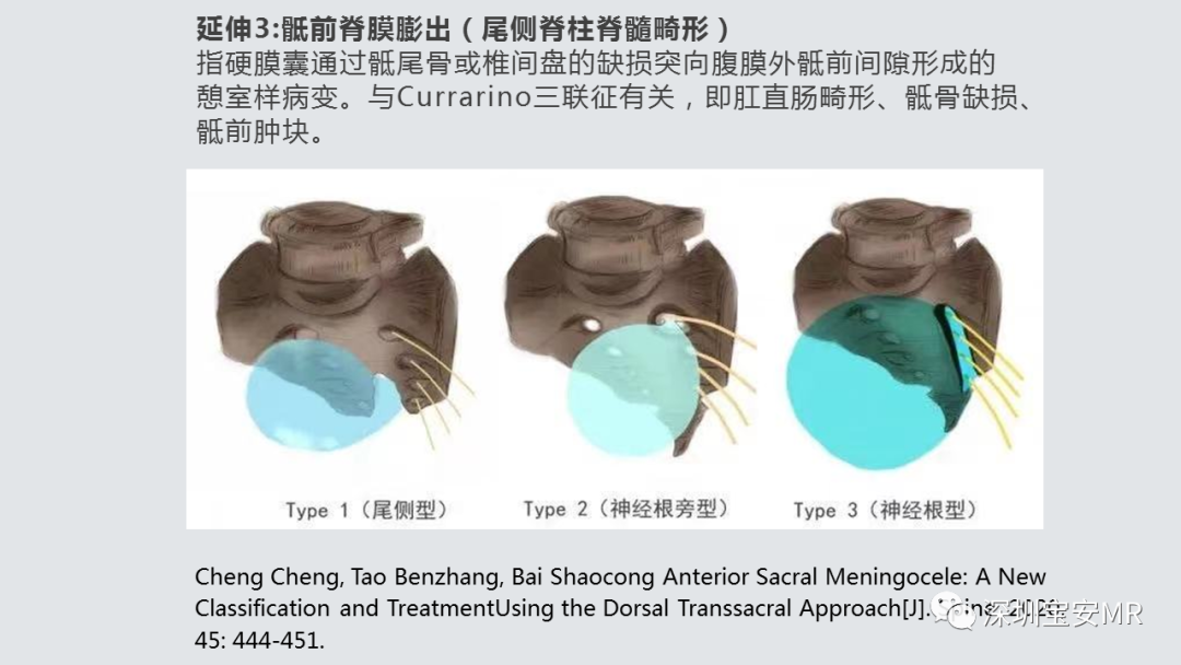 影像PPT - 【PPT】隐性神经管闭合不全的影像诊断-9