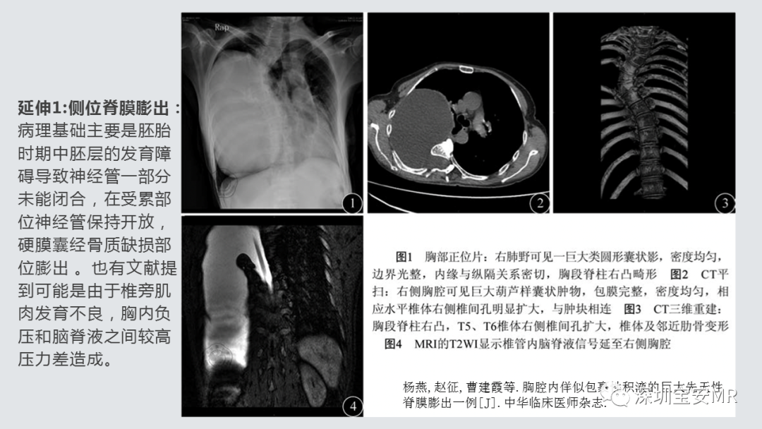 影像PPT - 【PPT】隐性神经管闭合不全的影像诊断-6
