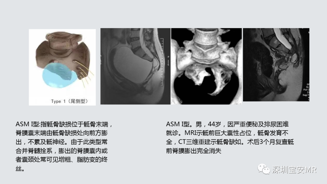 影像PPT - 【PPT】隐性神经管闭合不全的影像诊断-10